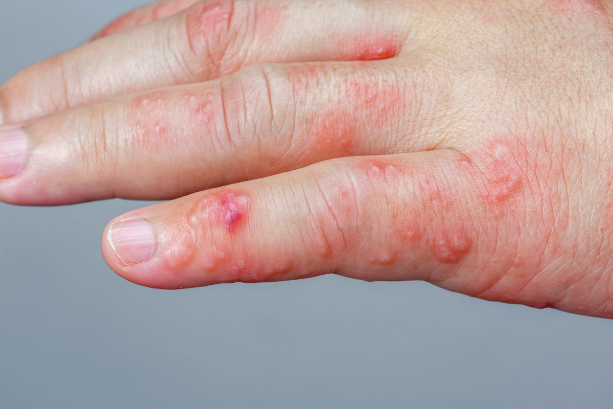 7-most-common-skin-rashes-in-the-united-states