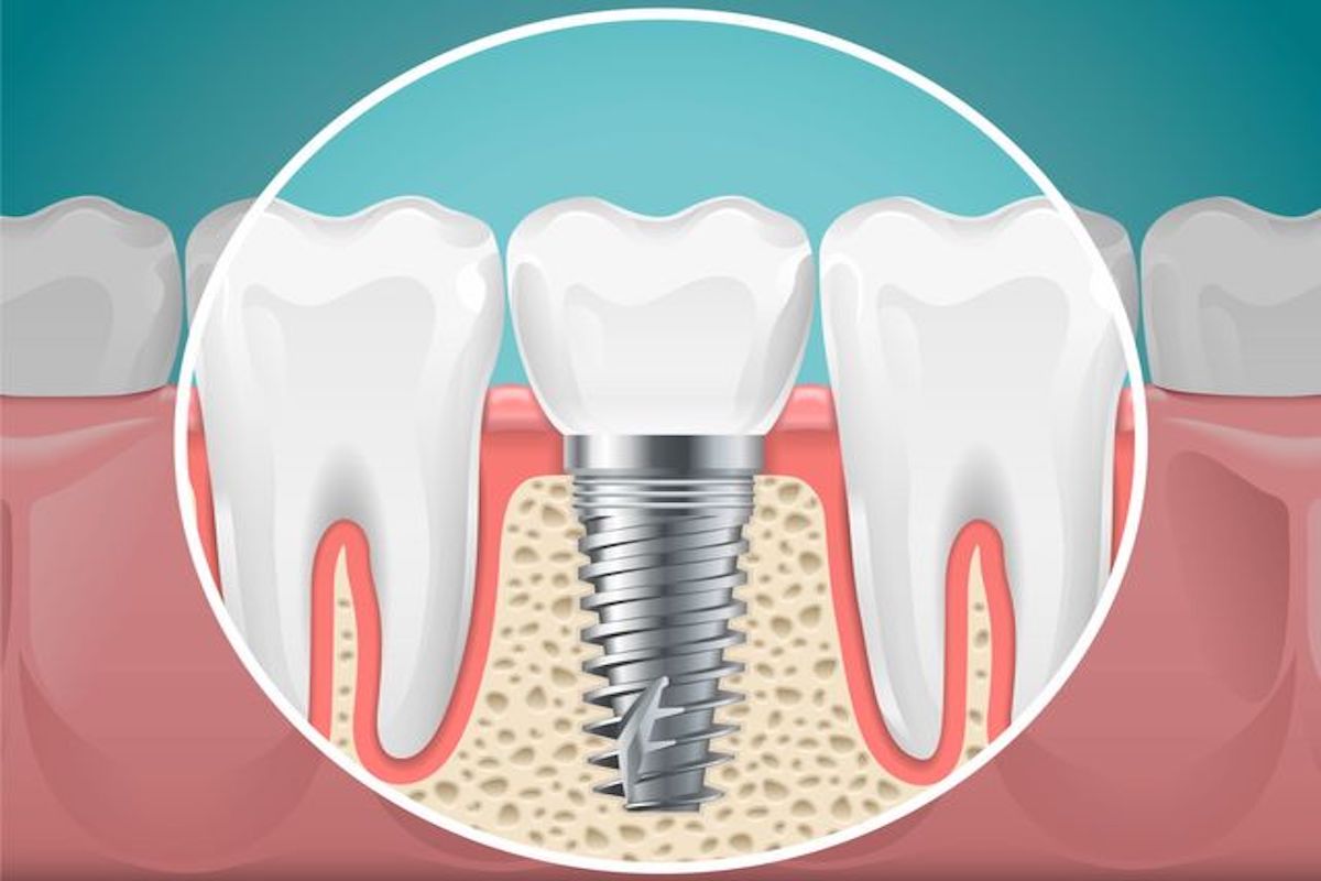 Dental Implants: Important Facts You Should Know About