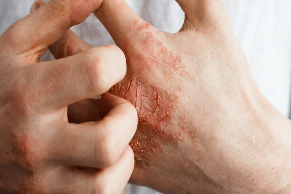 Understanding Atopic Dermatitis Causes Symptoms And Treatment Options