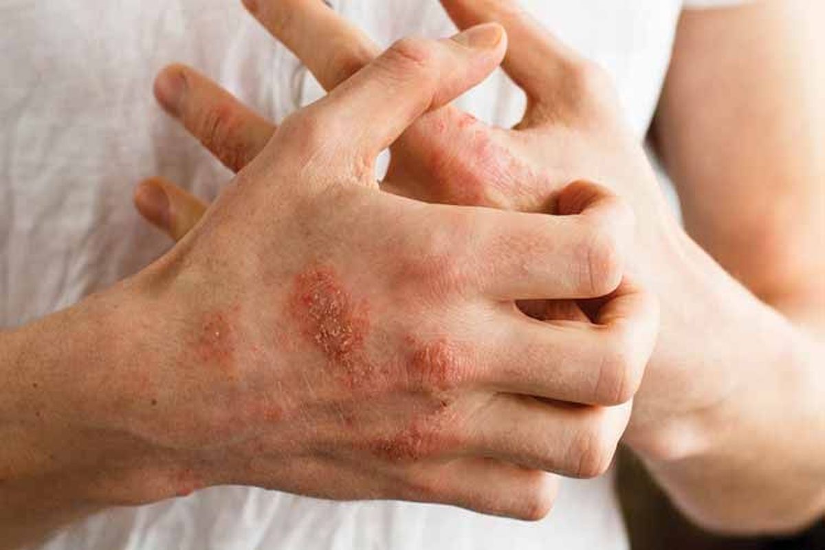 Everything You Need To Know About Eczema 9678