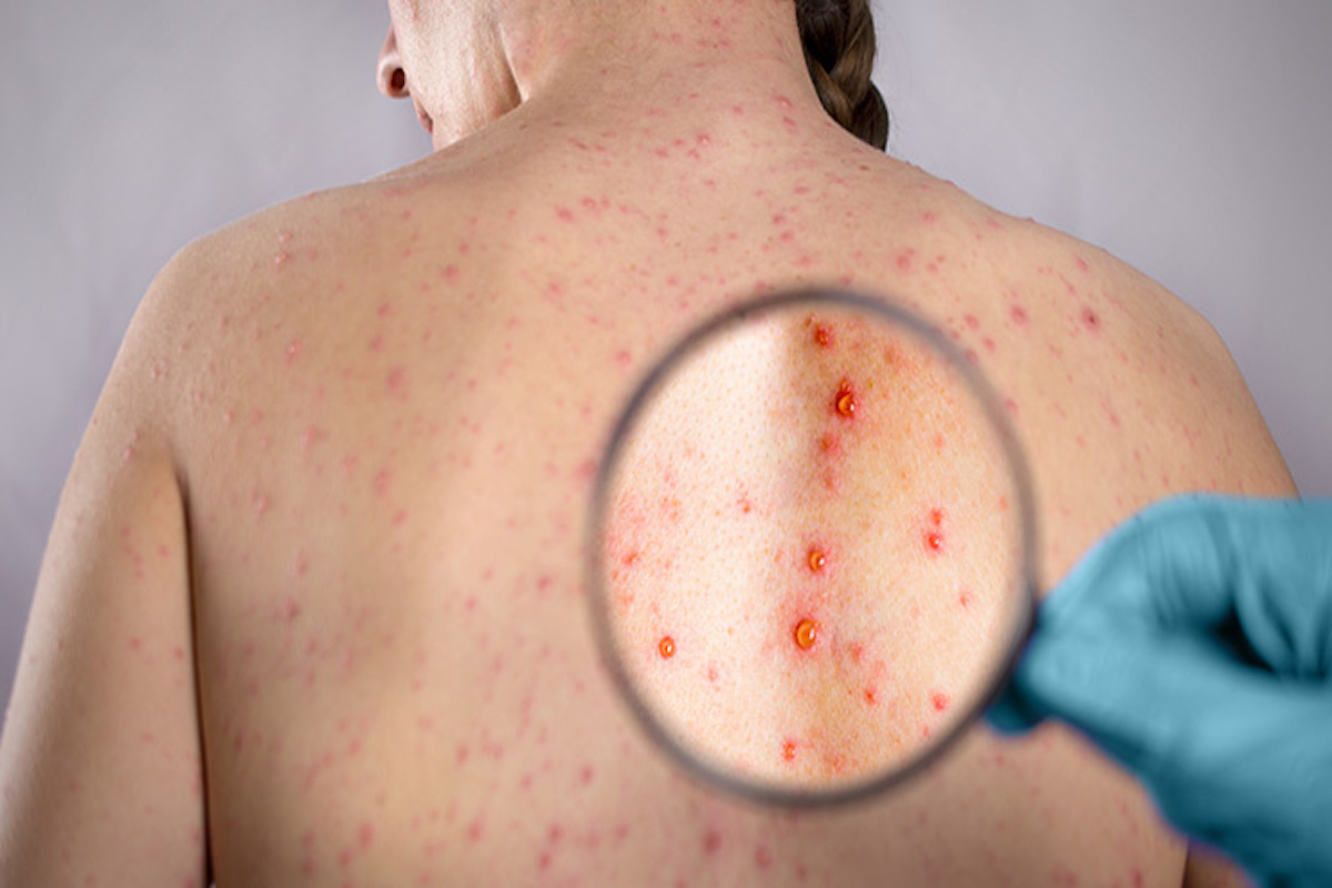 Shingles: Symptoms You Can’t Ignore and Treatment Options You Need to Know!