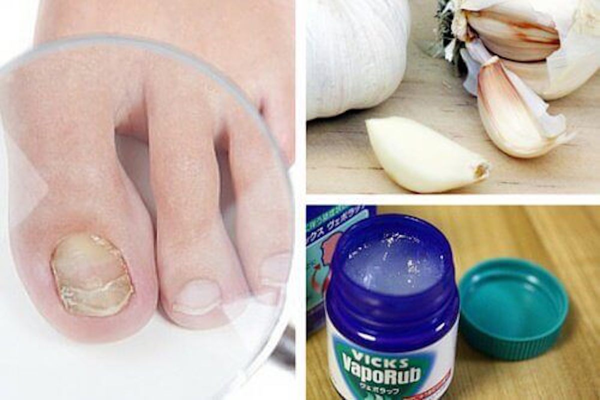 Get Rid of Your Toenail Fungus in This Bizarre Way