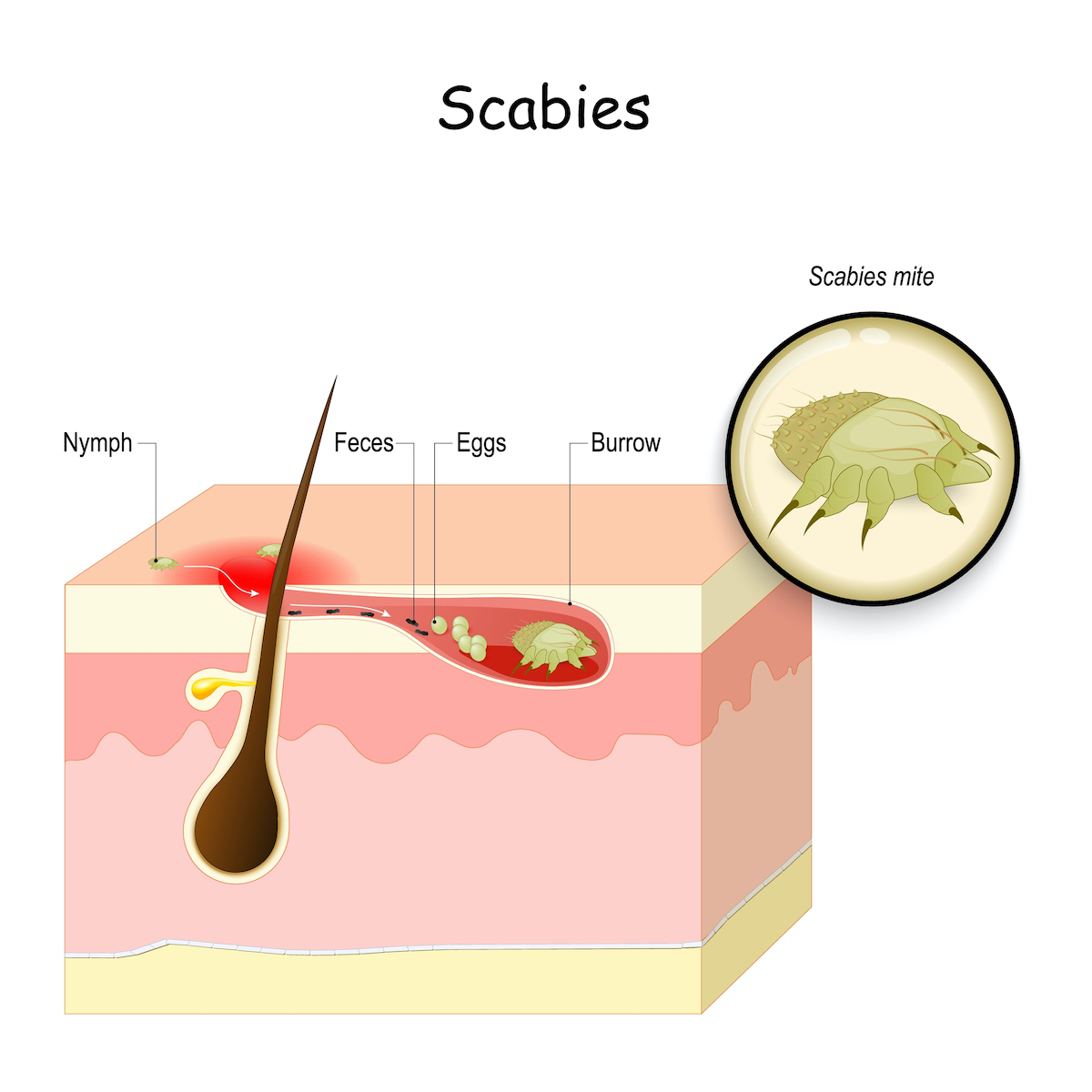 Scabies